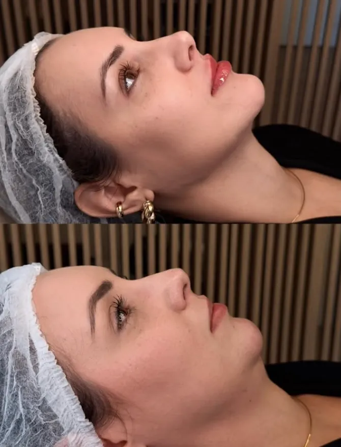 Comparação de perfil antes e depois de harmonização facial no Instituto Dal Prá